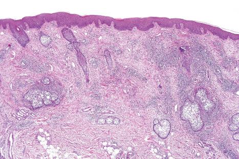 Fig. 29.83, Alopecia mucinosa: low-power view showing a striking perifollicular infiltrate. The patient did not have associated mycosis fungoides and the pathogenesis of this lesion is unknown.