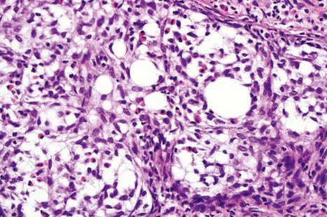 Fig. 29.84, Alopecia mucinosa: there is follicular mucinosis associated with a heavy eosinophil infiltrate.