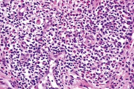 Fig. 29.85, Alopecia mucinosa: within the dermis is a dense lymphohistiocytic and eosinophil infiltrate. There are no atypical lymphocytes.