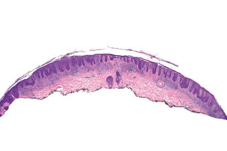 Fig. 29.87, Pagetoid reticulosis: scanning view showing characteristic psoriasiform hyperplasia.