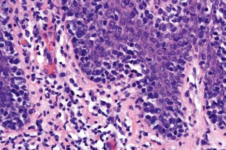 Fig. 29.90, Pagetoid reticulosis: note that the atypical lymphocytes are largely restricted to the epidermis.