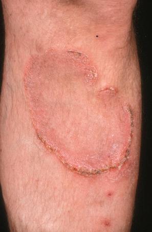 Fig. 29.9, Mycosis fungoides: high-power view.