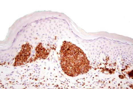 Fig. 29.91, Pagetoid reticulosis: the atypical lymphocytes can be highlighted with CD2 as shown in this example.