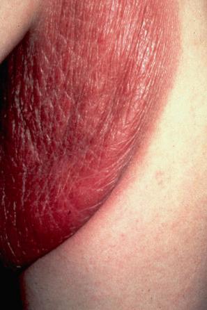 Fig. 29.92, Granulomatous slack skin: pendulous flexural folds of erythematous, indurated skin, as seen in this patient's axilla, are characteristic.