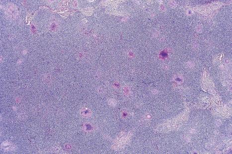 Fig. 29.93, Granulomatous slack skin: the dermis is extensively infiltrated by a dense lymphocytic infiltrate. Even at this magnification, multinucleate giant cells are conspicuous.