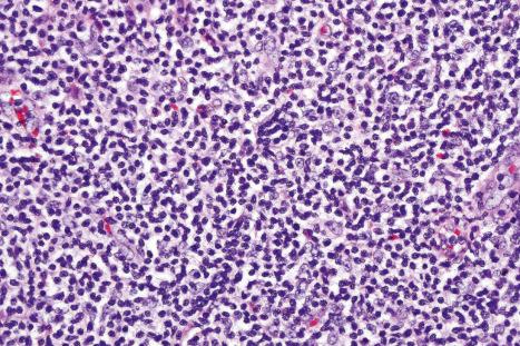 Fig. 29.94, Granulomatous slack skin: there is a background population of pleomorphic lymphocytes typical of mycosis fungoides.