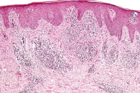 Fig. 29.99, Sézary syndrome: there is hyperkeratosis with acanthosis and a dense upper dermal lymphocytic infiltrate.