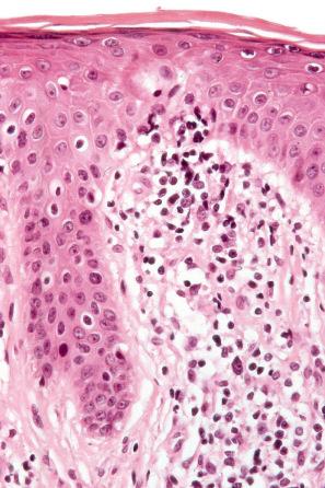 Fig. 29.100, Sézary syndrome: occasional atypical lymphocytes are present within both the epidermis and the dermis.