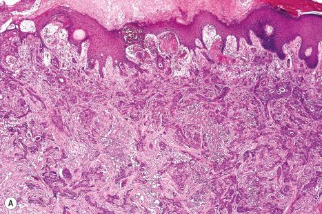 Fig. 30.1, Metastatic breast carcinoma: ( A ) this field shows metastatic poorly differentiated breast ductal carcinoma; ( B ) high-power view showing focal ductal differentiation.