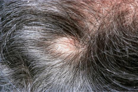 Fig. 30.11, Metastatic carcinoma of breast: scalp lesion associated with focal alopecia.