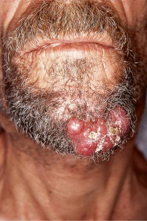 Fig. 30.14, Metastatic carcinoma: there are matted tumor nodules on the chin. The patient had a gastric carcinoma.