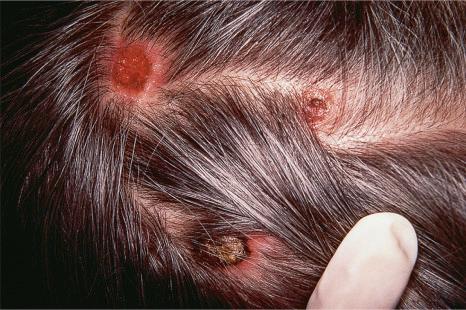 Fig. 30.15, Metastatic breast carcinoma: multiple tumor deposits are present on this patient's scalp – a common site of presentation following vascular invasion.