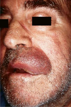 Fig. 30.17, Metastatic bronchial carcinoma: in this patient, the tumor deposit has resulted in a lymphedematous lesion.