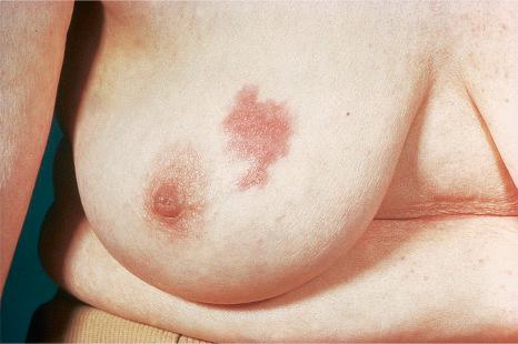 Fig. 30.18, Metastatic carcinoma of breast: an inflammatory cutaneous metastasis usually presents as a tender, warm, erythematous plaque.