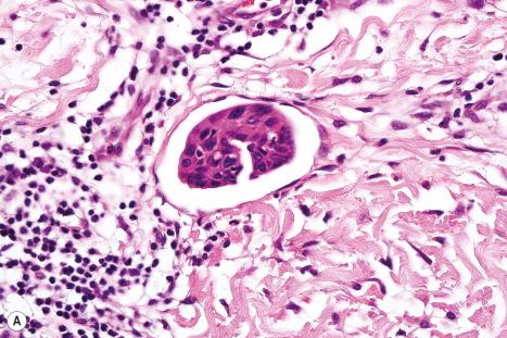 Fig. 30.2, Metastatic breast carcinoma: ( A ) lymphovascular invasion is present; ( B ) the vessel endothelium shows strong D2-40 expression.