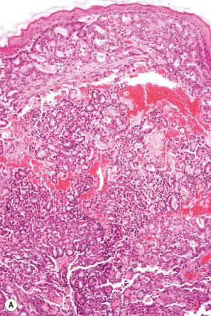 Fig. 30.23, Metastatic pancreatic carcinoma: ( A ) low-power view; ( B ) the tumor shows a well-developed glandular structure.