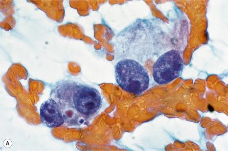 Fig. 30.26, Fine needle aspirate: this is an example of metastatic malignant melanoma. Note ( A ) the large nucleoli and ( B ) the intracytoplasmic pigment.