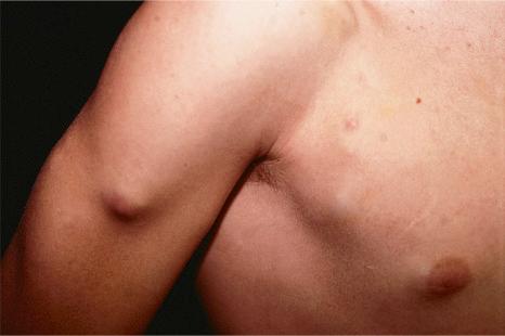 Fig. 30.6, Metastatic neuroblastoma: there are multiple metastases on the chest wall and arm.