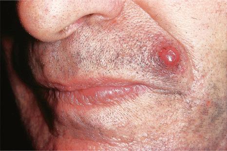 Fig. 30.10, Metastatic renal cell carcinoma: cutaneous metastases are typically erythematous and vascular, and may be misdiagnosed as pyogenic granuloma.