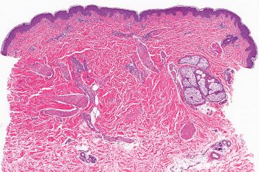 Fig. 1, Smooth muscle hamartoma.