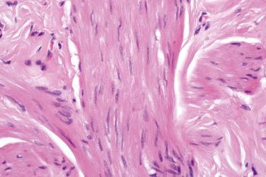 Fig. 4, Nipple leiomyoma.