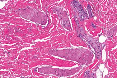 Fig. 2, Smooth muscle hamartoma.