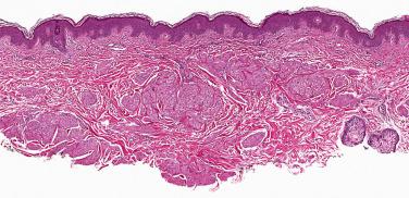 Fig. 1, Pilar leiomyoma.