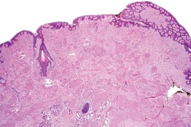 Fig. 1, Nipple leiomyoma.