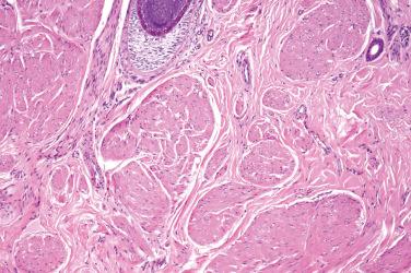 Fig. 2, Nipple leiomyoma.