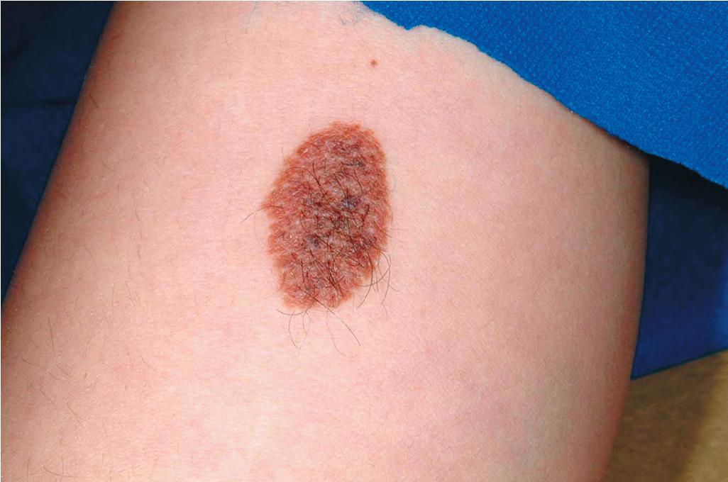 Fig. 9.11, Congenital melanocytic nevus. A well-demarcated, brown plaque with some pigment variation and hypertrichosis.