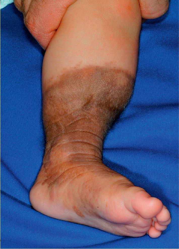 Fig. 9.12, Congenital nevus of the lower extremity. Note the limb hypoplasia in the ankle region associated with this circumferential lesion.