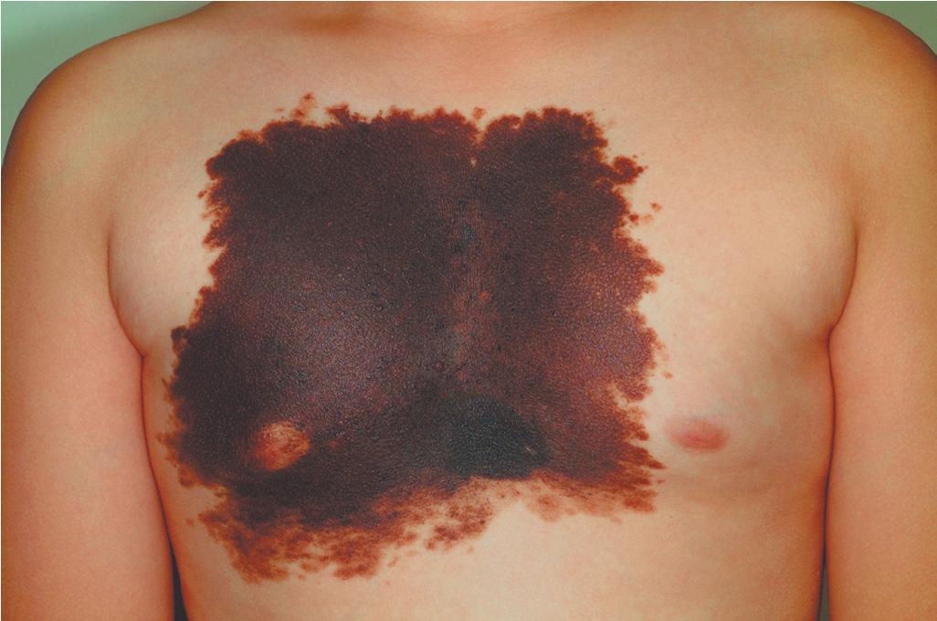 Fig. 9.13, Large congenital melanocytic nevus.