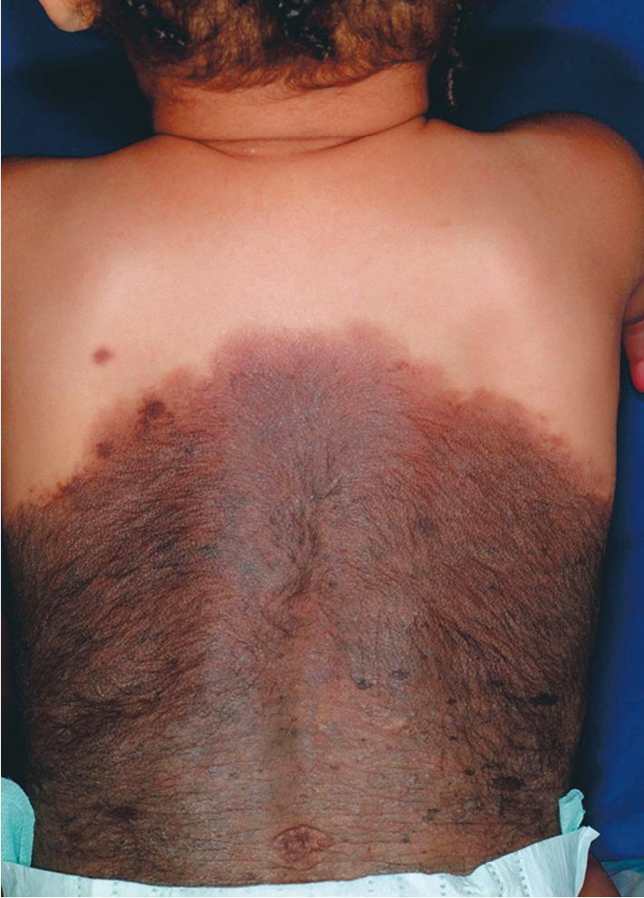 Fig. 9.14, Giant congenital melanocytic nevus. Note the marked hypertrichosis and adjacent satellite lesions.