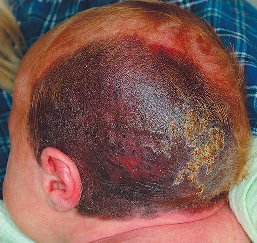 Fig. 9.15, Giant congenital melanocytic nevus with erosions. Surface erosion and crusting was present at birth and healed rapidly over a few weeks with topical care.