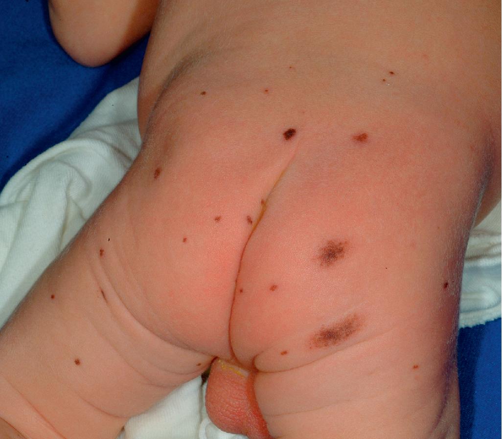 Fig. 9.16, Satellite melanocytic nevi. This patient had a giant nevus of the scalp.