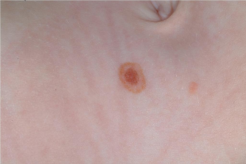 Fig. 9.19, Cockade nevus. This pattern refers to a central darkly pigmented portion surrounded by an intervening rim of minimal to no pigmentation and an outer rim of darker pigment, giving a target-like appearance. These nevi are usually benign.