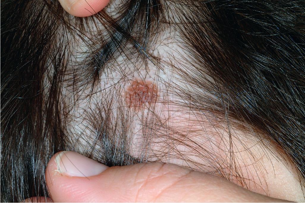 Fig. 9.20, Scalp nevus. These nevi may be larger and often reveal irregular borders and color variation, although the majority of them are histologically benign.
