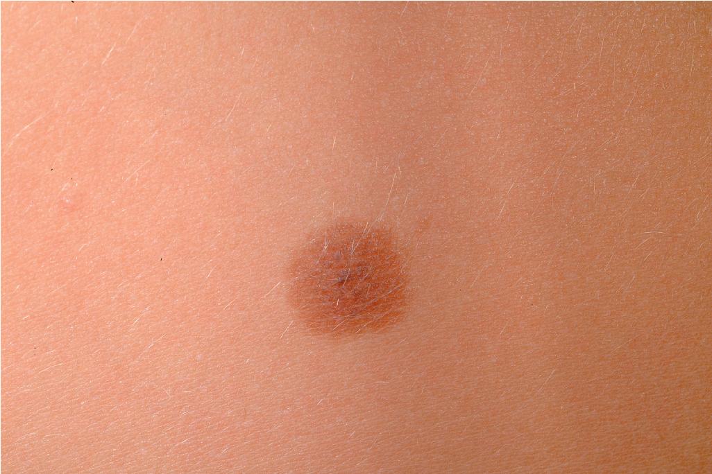 Fig. 9.2, Compound melanocytic nevus. A well-demarcated, tan papule with some darker speckling centrally.