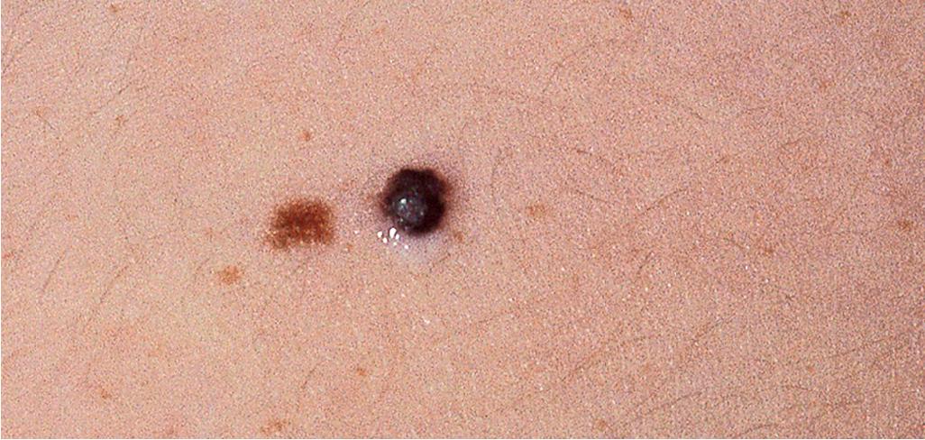 Fig. 9.22, Malignant melanoma. This small, black papule was noted on a 10-year-old boy with fair skin and red hair; excision confirmed a nodular malignant melanoma.