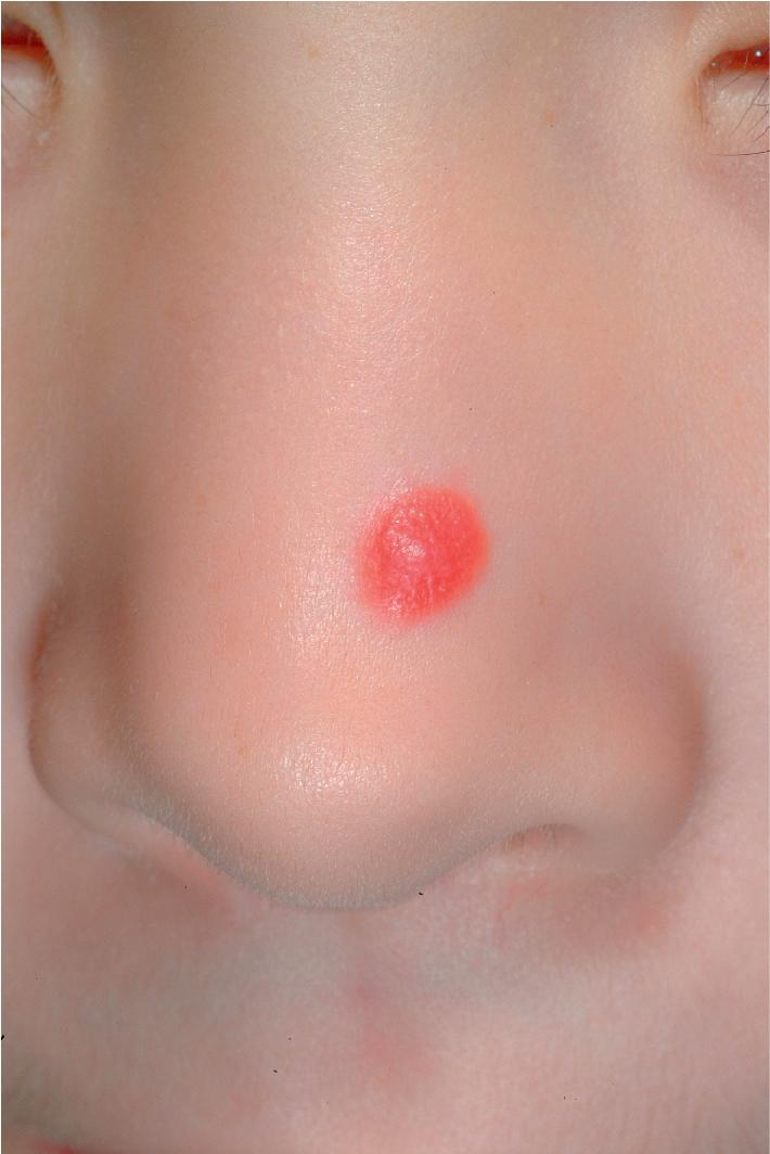 Fig. 9.23, Spitz nevus. This patient had the erythematous type of Spitz nevus on her nose.