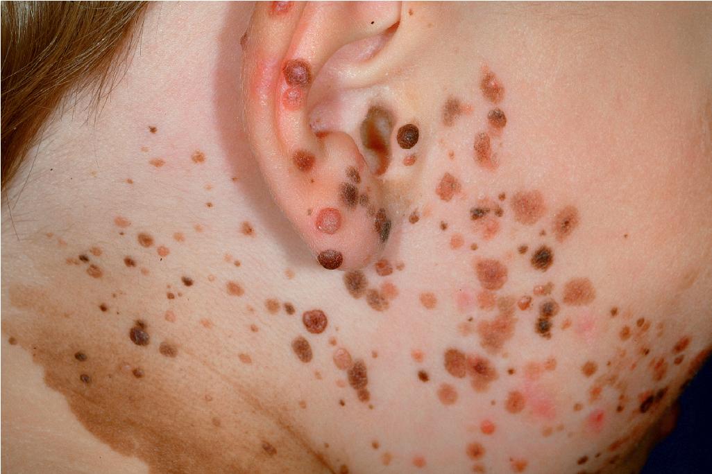 Fig. 9.24, Agminated Spitz nevi. This child had multiple lesions of the lateral cheek, ear, and neck, several of which were excised, revealing characteristic histologic features of Spitz nevus.