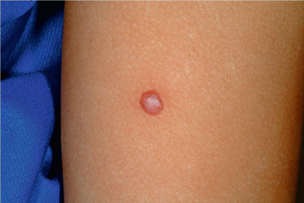 Fig. 9.25, Spitz nevus. This pink papule reveals brown speckling, which was easier to see when pressure was applied with a glass slide (diascopy).