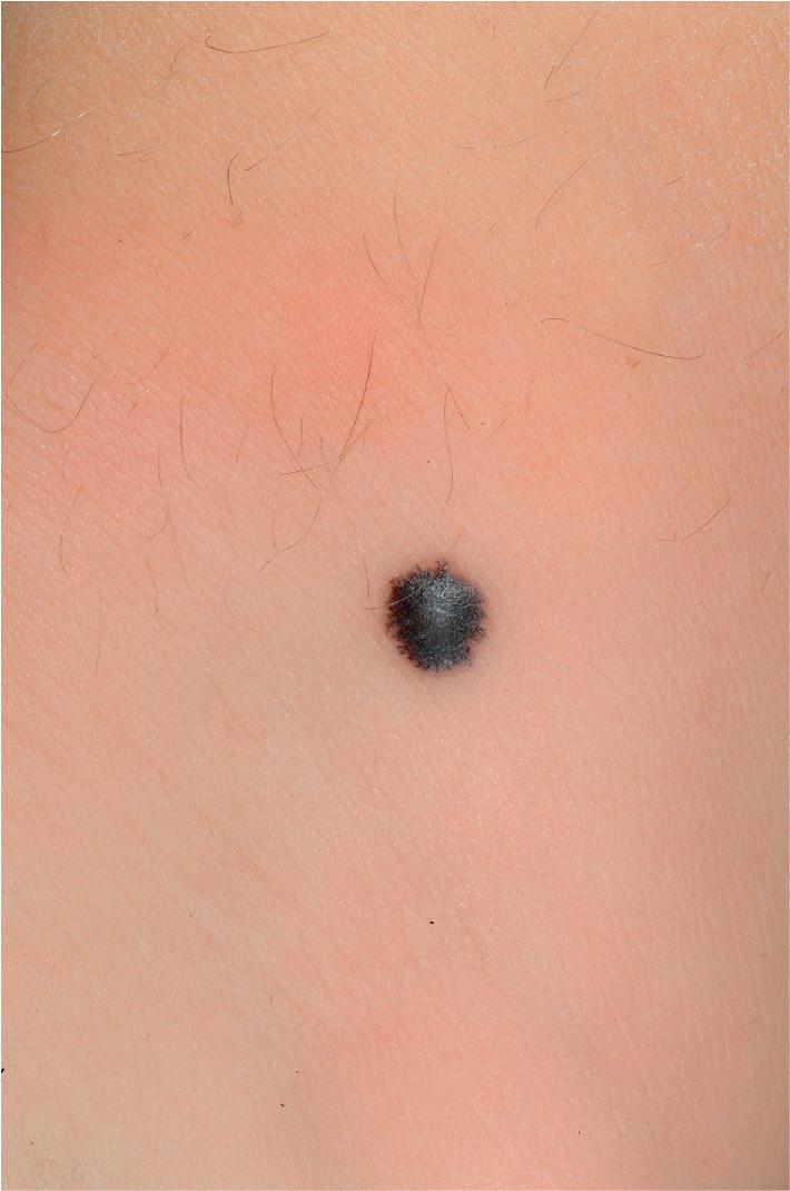 Fig. 9.26, Spitz nevus. The dark brown or black type is most often confused clinically with malignant melanoma.