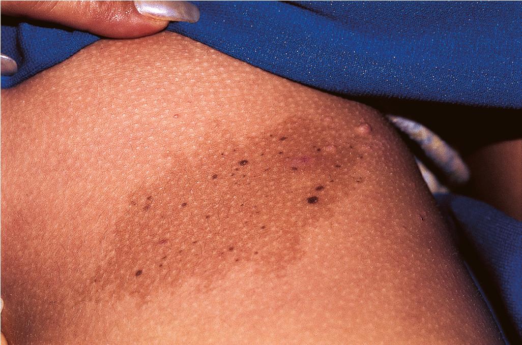 Fig. 9.29, Nevus spilus. A tan patch is studded with numerous darker brown macules and papules.