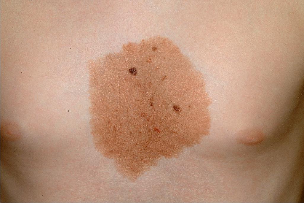 Fig. 9.30, Nevus spilus. This larger patch on the chest of a young boy reveals numerous superimposed nevi along with mild hypertrichosis.