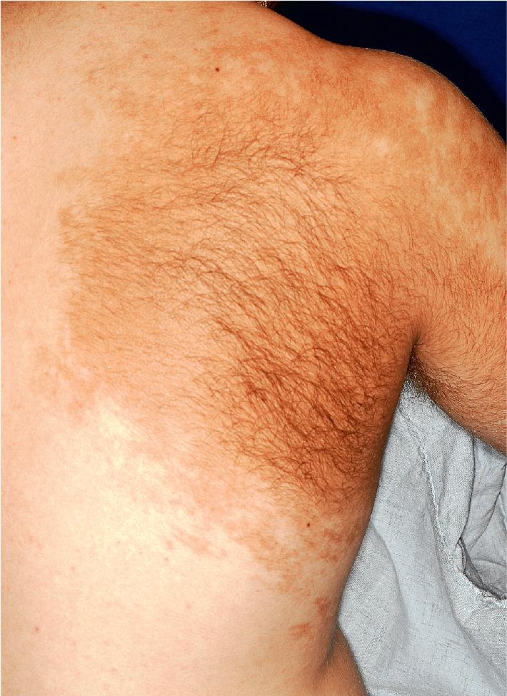 Fig. 9.31, Becker melanosis. This adolescent boy has hyperpigmentation of the upper back and shoulder with extension onto the right upper chest in association with surface hypertrichosis.