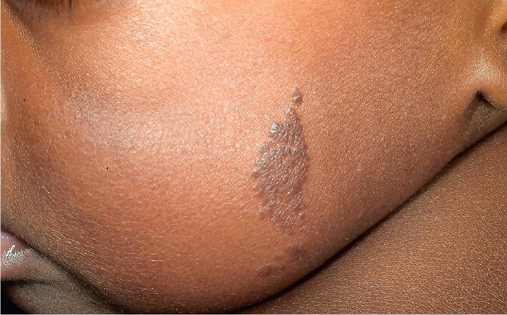 Fig. 9.32, Epidermal nevus. This multifocal, verrucous plaque was present since birth.