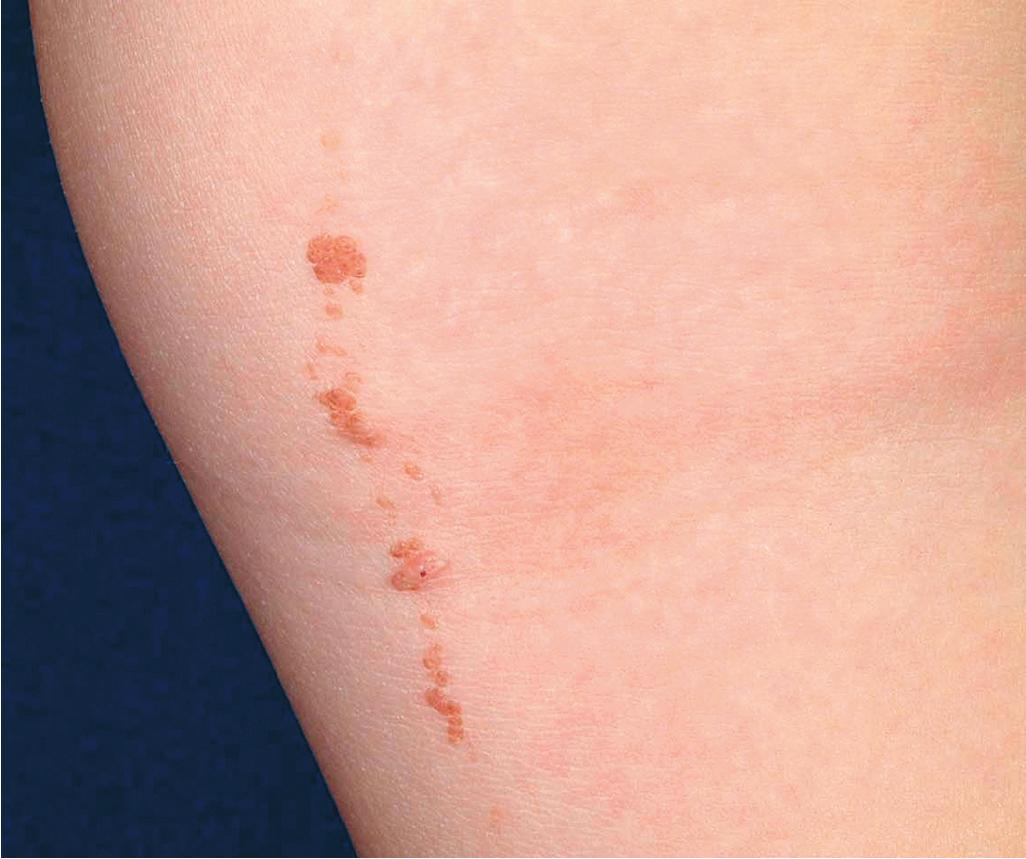 Fig. 9.33, Epidermal nevus. Note the warty nature and linear configuration.