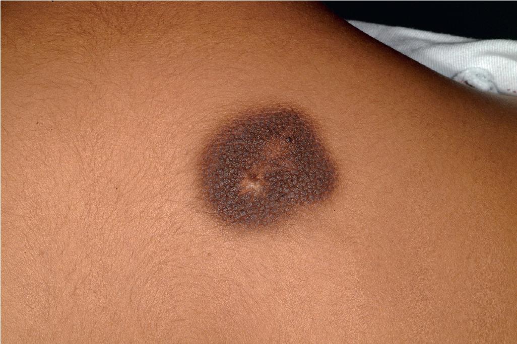 Fig. 9.35, Acanthosis nigricans form of epidermal nevus. This form of epidermal nevus reveals a well-demarcated area of velvety thickening, as classically seen with more widespread acanthosis nigricans.