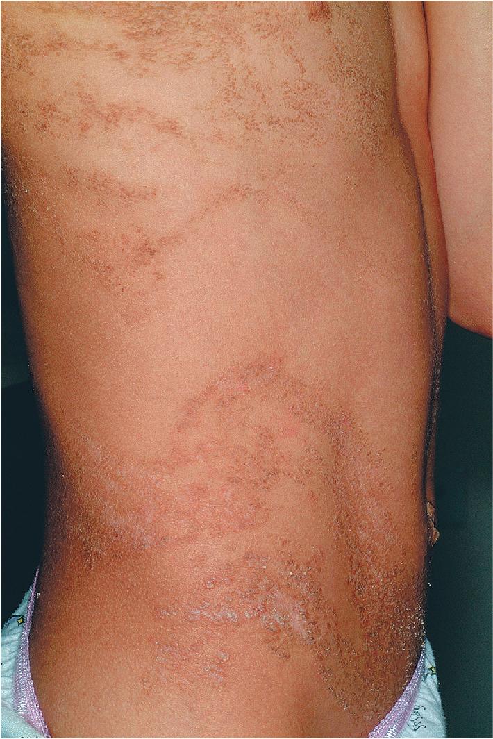 Fig. 9.36, Nevus unius lateris. Numerous linear and whorled lesions were present on the right side of this 10-year-old girl.